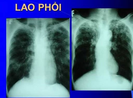 Nguyên Nhân Nào Bị Bệnh Phổi? 6 nguyên nhân nào bị bệnh phổi?