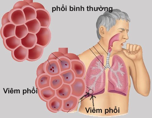 Nguyên Nhân Nào Bị Bệnh Phổi? 8 nguyên nhân nào bị bệnh phổi?