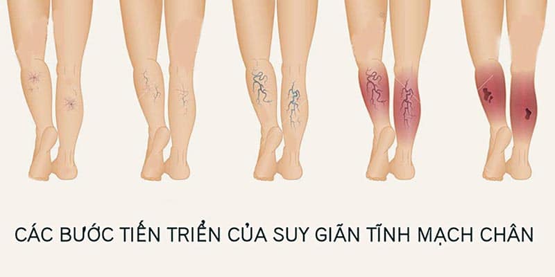 Suy Giãn Tĩnh Mạch Chân: Nguyên Nhân Triệu Chứng Và Cách Chẩn Đoán 8 suy giãn tĩnh mạch chân: nguyên nhân triệu chứng và cách chẩn đoán