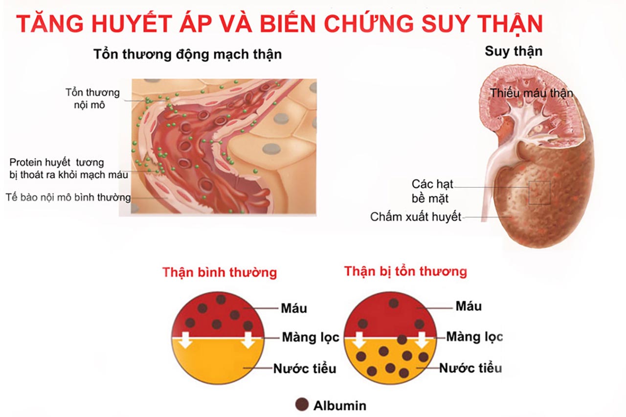 Biến Chứng Thận Do Tăng Huyết Áp 7 biến chứng thận do tăng huyết áp