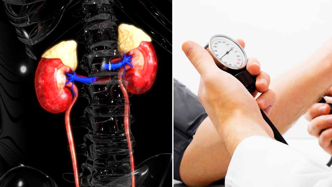 Biến Chứng Thận Do Tăng Huyết Áp 6 biến chứng thận do tăng huyết áp