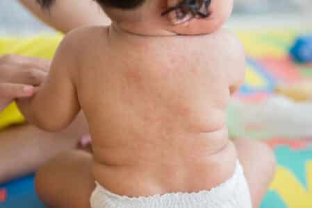 Cách Xử Trí Khi Trẻ Sốt Phát Ban 5 dấu hiệu trẻ bị sốt phát ban