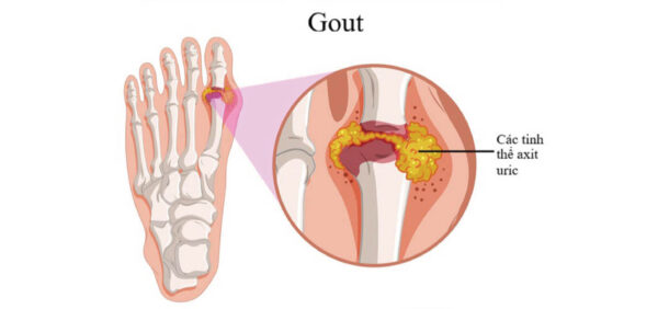 Những Dấu Hiệu Bệnh Gút. Người Mắc Bệnh Gout Kiêng Ăn Gì? 14 những dấu hiệu bệnh gút. người mắc bệnh gout kiêng ăn gì?