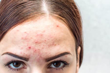 vị trí mọc mụn cảnh báo vấn đề sức khỏe