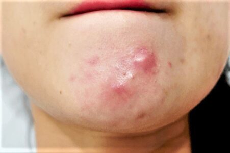 vị trí mọc mụn bcarnh báo vấn đề về sức khỏe