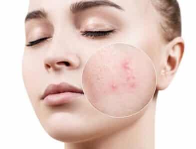 vị trí mọc mụn cảnh báo vấn đề về sức khỏe