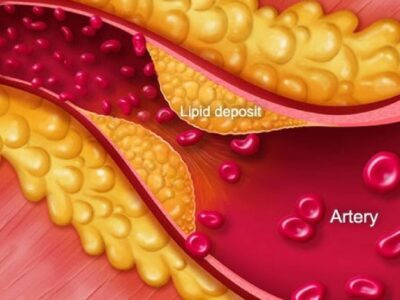 Người Béo Phì Dễ Mắc Những Bệnh Gì? 11 người béo phì
