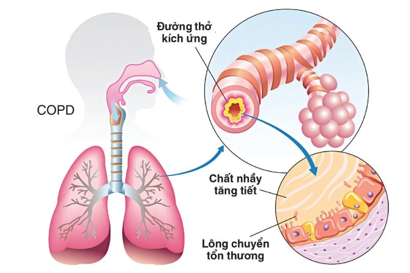Viêm Phế Quản Mãn Tính Có Chữa Dứt Điểm Được Không? 3 bệnh viêm phế quản mãn tính gây tổn thương niêm mạc phế quản