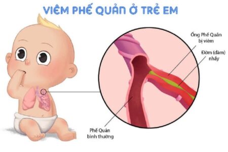 viêm phế quản ở trẻ làm suy yếu sức khỏe nhanh chóng