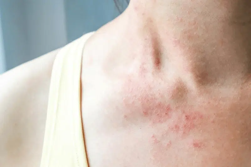 máy lọc không khí ion âm có thể giúp làm giảm tỉ lệ dị ứng